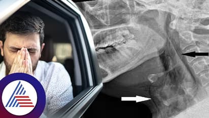 Driving Man Tears His Windpipe Holding Sneeze In A Rare World First