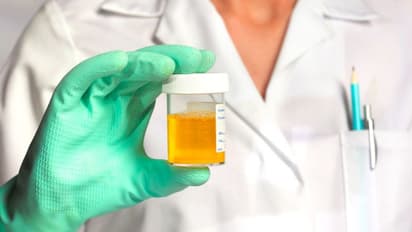 മൂത്രത്തിന് കടും മഞ്ഞ നിറമാണോ? എന്നാൽ ഇതൊന്ന് അറിഞ്ഞിരിക്കാം... 