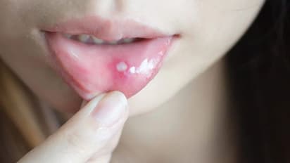 Health Tips: വായ്പ്പുണ്ണ് മാറാന് വീട്ടില് പരീക്ഷിക്കാം ഇക്കാര്യങ്ങള്...