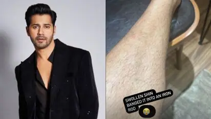 Varun Dhawan gets injured while shooting for upcoming film, shares update on swollen leg