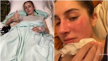 മുഖമാകെ എരിയുന്നതായി തോന്നും, ഉരുകിയത് പോലാകും; അപൂര്‍വ രോഗം ബാധിച്ച യുവതി!