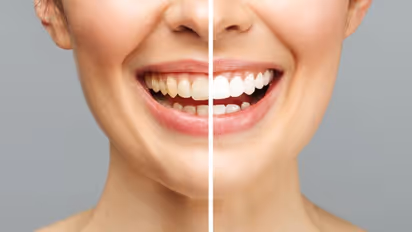பற்களை எப்படி துலக்கினாலும் மஞ்சள் கறை மட்டும் போகலையா? வெள்ளையாக மாற சூப்பர் டிப்ஸ் இதோ!!