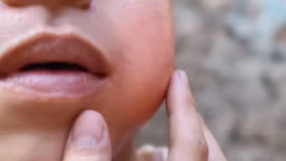 കേരളത്തില് മുണ്ടിനീര് പടരുന്നു, ഒരു ദിവസം 190 കേസുകളുടെ വർദ്ധനവ്, അറിയാം രോഗ ലക്ഷണങ്ങള്...