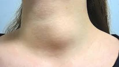 Health Tips: തൈറോയ്ഡ് ക്യാൻസറിന്റെ ഈ ലക്ഷണങ്ങളെ നിസാരമായി കാണരുതേ...