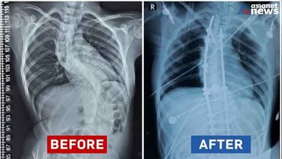 എപിഫൈസിയല് ഡിസ്പ്ലേസിയ ബാധിച്ച കുഞ്ഞ് ഫാത്തിമ; നവകേരള സദസ് തലസ്ഥാനത്ത് അവസാനിക്കുമ്പോൾ നിവർന്ന് നടക്കും!