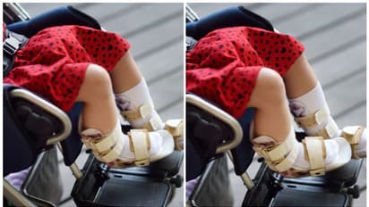 'രോഗിയായ കുട്ടിയെ ആശുപത്രിയിലെത്തിക്കാൻ മിനി ആംബുലൻസെങ്കിലും പോകുന്ന വഴി വേണം': ഇടപെട്ട് മനുഷ്യാവകാശ കമ്മീഷൻ 