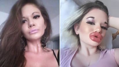 'ലോകത്തിലെ ഏറ്റവും വലിയ ചുണ്ടുള്ള സ്ത്രീ'; വലിപ്പം കൂട്ടിക്കൂട്ടി ജീവൻ പോകുമോ? ആശങ്കയിലെന്ന് ബന്ധുക്കൾ