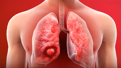 തിരിച്ചറിയാം ലങ് ക്യാൻസറിന്റെ പ്രധാനപ്പെട്ട മൂന്ന് ലക്ഷണങ്ങൾ...