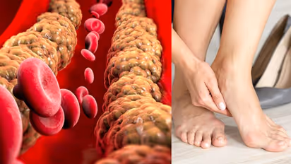 കാലുകളില്‍ കാണുന്ന ഈ ലക്ഷണങ്ങള്‍ ചീത്ത കൊളസ്ട്രോളിന്‍റെയാകാം... 
