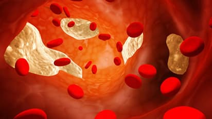 ചീത്ത കൊളസ്ട്രോള്‍ കുറയ്ക്കാന്‍ ഒഴിവാക്കേണ്ട ഭക്ഷണങ്ങള്‍... 