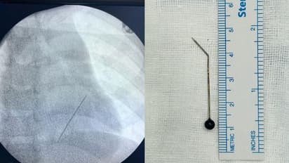 രക്തസ്രാവം, അവശനിലയിലായി 7 വയസുകാരന്‍, കാരണം ശ്വാസകോശത്തിൽ കുടുങ്ങിയ 5സെന്‍റിമീറ്റർ നീളമുള്ള ഹിജാബ് പിന്‍ 