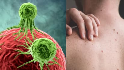 ക്യാന്‍സര്‍; ശരീരം മുൻകൂട്ടി കാണിക്കുന്ന ചില ലക്ഷണങ്ങൾ...