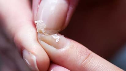 കാത്സ്യത്തിന്റെ കുറവ് ; ഈ ലക്ഷണങ്ങൾ അവഗണിക്കരുത്