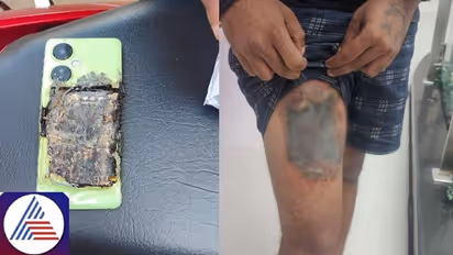 Bengaluru: New Oneplus device explodes in pocket, customer seeks full medical coverage from company