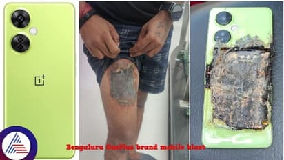 ಹೊಸ ಒನ್‌ಪ್ಲಸ್ ಮೊಬೈಲ್‌ ಬ್ಲಾಸ್ಟ್‌: ಬೆಂಗಳೂರು ಯುವಕನ ತೊಡೆ ಭಾಗ ಊಸ್ಟ್‌!