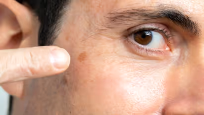 ചര്മ്മത്തിലെ ഈ മാറ്റങ്ങള് സ്കിന് ക്യാന്സറിന്റെ ലക്ഷണമാകാം, അവഗണിക്കല്ലേ...