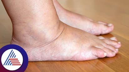 ಇದ್ದಕ್ಕಿದ್ದಂತೆ ಕಾಲು ಊದ್ಕೊಂಡ್ರೆ ಲಿವರ್ಗೇನೋ ಆಗಿರುತ್ತೆ! ಆರೋಗ್ಯ ಜೋಪಾನ!