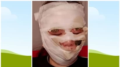 അതിഥികള് വിവാഹം 'ആഘോഷിച്ചു'; വിവാഹ ദിനം മുഖത്ത് ഗുരുതരമായി പൊള്ളലേറ്റ വധു ആശുപത്രിയില് !