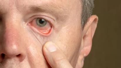 കൊളസ്ട്രോള് വല്ലാതെ കൂടിയെന്ന് സൂചിപ്പിക്കുന്ന ലക്ഷണങ്ങള്...