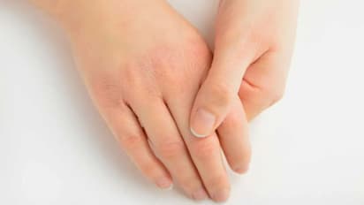 വിറ്റാമിന് 'എ'യുടെ അഭാവം; തിരിച്ചറിയാം ഈ ഏഴ് ലക്ഷണങ്ങളിലൂടെ...