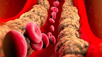 ചീത്ത കൊളസ്ട്രോളിനെ നിസാരമാക്കരുത്, ഡയറ്റില് ഉള്പ്പെടുത്താം ഈ ഭക്ഷണങ്ങള്...