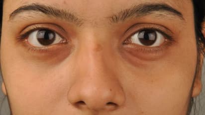 കൺതടങ്ങളിലെ ഇരുണ്ട നിറം; അറിയാം കാരണങ്ങളും പൊടിക്കൈകളും...