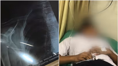 യൂണിഫോമിന്റെ ബട്ടന്‍ ഇടണമെന്ന് പറഞ്ഞ് സീനിയർ വിദ്യാർത്ഥികളുടെ മർദനം; പ്ലസ് വൺ വിദ്യാർത്ഥിയുടെ തോളെല്ല് പൊട്ടി