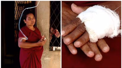 സുലോചനക്ക് ആശ്വാസം; രണ്ടരലക്ഷം നഷ്ടപരിഹാരം നൽകുമെന്ന് മന്ത്രി; വിരൽ പോയത് കാട്ടുപന്നിയുടെ ആക്രമണത്തില്