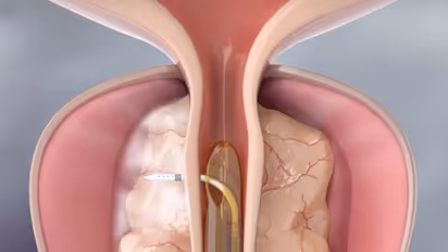 പ്രോസ്റ്റേറ്റ് വീക്കത്തിന് റീസം വാട്ടർ തെറപ്പി; ദക്ഷിണേന്ത്യയിൽ ആദ്യമെന്ന് ആസ്റ്റർ മെഡ്സിറ്റി