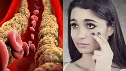 ശരീരത്തിലെ ഈ മൂന്ന് ഇടങ്ങളിലെ ലക്ഷണങ്ങള് ചീത്ത കൊളസ്ട്രോളിന്റെയാകാം...