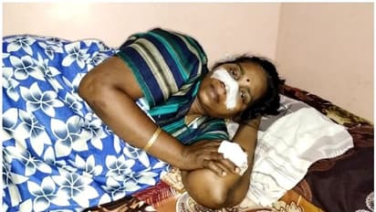 തിരുവനന്തപുരത്ത് ഭർത്താവ് ഭാര്യയുടെ മൂക്ക് വെട്ടി; പ്രതി ഒളിവില്