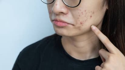 മുഖക്കുരുവിന്റെ പാട് മാറാൻ എളുപ്പത്തില് ചെയ്യാവുന്ന പൊടിക്കൈകള്