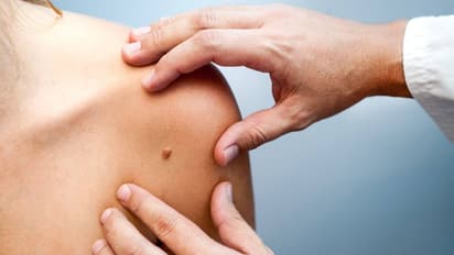 World Cancer Day 2024 : ക്യാൻസർ ; ശരീരം മുൻകൂട്ടി കാണിക്കുന്ന 6 ലക്ഷണങ്ങൾ