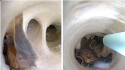 ചികിത്സയ്ക്കിടെ വയറ്റിനുള്ളില് ജീവനുള്ള പുഴുക്കള് നുരയ്ക്കുന്നത്; അപൂര്വമായ കാഴ്ചയുടെ വീഡിയോ