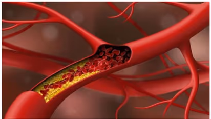 ഇവ കഴിച്ചോളൂ, ഉയർന്ന കൊളസ്ട്രോൾ കുറയ്ക്കാൻ സഹായിക്കും