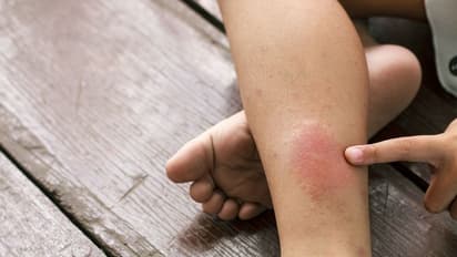 രക്തം കട്ടപിടിക്കുന്നത് ; ഇക്കാര്യങ്ങൾ അറിഞ്ഞിരിക്കൂ