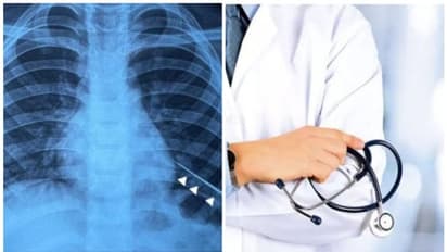 9 വയസ്സുകാരൻ്റെ ശ്വാസകോശത്തിൽ നിന്ന് തുന്നൽ സൂചി പുറത്തെടുത്ത് ഡോക്ടർമാർ