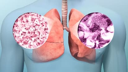 Lung cancer: धीरे-धीरे लाखों जिंदगी निगल रहा लंग कैंसर, कहीं आप भी तो नहीं कर रहे ये गलतियां 