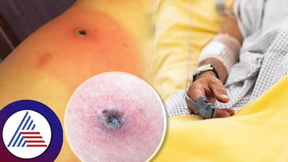 Health: ಅಲಾಸ್ಕಾಪಾಕ್ಸ್ಗೆ ಮೊದಲ ಸಾವು, ಏನಿದರ ಲಕ್ಷಣ?