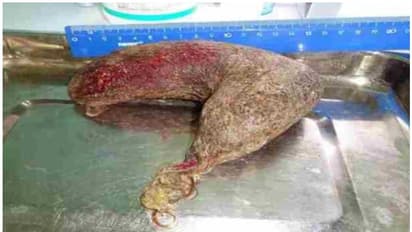 കുട്ടിക്ക് വിശപ്പില്ല, സ്കാൻ റിപ്പോർട്ടിൽ ഞെട്ടി ഡോക്ടർമാർ; മണിക്കൂറുകൾ നീണ്ട സർജറി, വയറ്റിൽ ഭീമൻ മുടിക്കെട്ട്