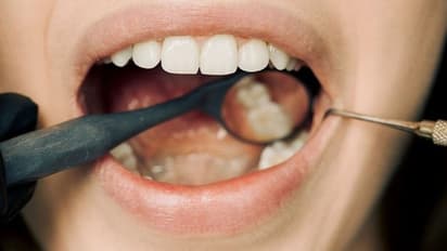 ഞെട്ടിക്കുന്ന പഠനം! പുകയില ഉപയോഗമില്ല, മദ്യപാന ശീലവുമില്ല; പക്ഷെ ഇവരിലും ഓറൽ കാൻസര് കേസുകൾ ഗണ്യമായി കൂടുന്നു