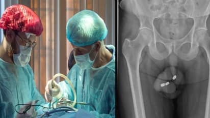 ಲೈಂಗಿಕ ತೃಪ್ತಿಗಾಗಿ ಶಿಶ್ನಕ್ಕೆ ಬ್ಯಾಟರಿ ಹಾಕಿಕೊಂಡ 71ರ ವೃದ್ಧ, ಮುಂದಾಗಿದ್ದೇನು?