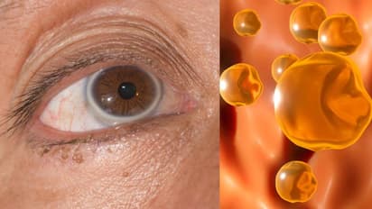 പുരുഷന്മാരുടെ കണ്ണുകളിൽ കാണുന്ന ഈ ലക്ഷണങ്ങൾ ഉയർന്ന കൊളസ്ട്രോളിന്‍റെയാകാം...