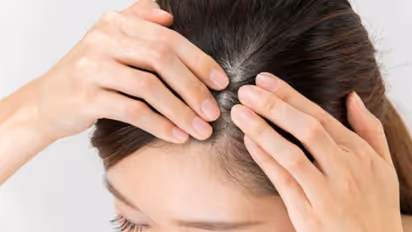 തലയോട്ടിയിലെ സോറിയാസിസ്; ഈ ലക്ഷണങ്ങളെ നിസാരമായി കാണരുത്...