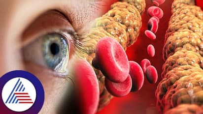 Health tips: ಕೊಲೆಸ್ಟ್ರಾಲ್ ಹೆಚ್ಚಾದಾಗ ಕಣ್ಣಲ್ಲಾಗುವ ಈ ಬದಲಾವಣೆ ನಿಮ್ಮನ್ನು ಕುರುಡು ಮಾಡ್ಬಹುದು…