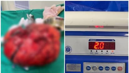 60കാരന്റ കഴുത്തിൽ പത്ത് വർഷമായി വളരുന്ന മുഴ, 2 കിലോ ഭാരം; താലൂക്ക് ആശുപത്രിയിലെ ശസ്ത്രക്രിയയിൽ നീക്കം ചെയ്തു