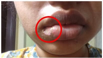 പല്ല് പറിക്കുന്നതിനിടയിയിൽ രോ​ഗിയുടെ കീഴ്ചുണ്ട് മുറിച്ച് വിവാദ ദന്താശുപത്രി; പരാതി തരൂവെന്ന് പോലീസ് !