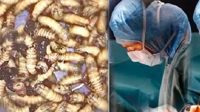 ಮುಖ, ತುಟಿ ಊದಿಕೊಂಡಿದ್ದ ವ್ಯಕ್ತಿಯ ಟೆಸ್ಟ್ ಮಾಡಿದ ವೈದ್ಯರಿಗೇ ಶಾಕ್, ಮೂಗಿನೊಳಗೆ ಅಂಟಿಕೊಂಡಿತ್ತು 150 ಹುಳು!