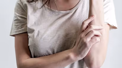 കടുത്ത പനി, തലവേദന, തൊലിപ്പുറത്ത് ചുവന്ന കുമിളകള്‍; വേനൽക്കാലത്തെ ഈ ലക്ഷണങ്ങളെ നിസാരമായി കാണേണ്ട... 