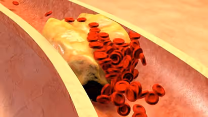 ചീത്ത കൊളസ്ട്രോൾ കുറയ്ക്കാൻ ദിവസവും ചെയ്യേണ്ട ഏഴ് കാര്യങ്ങൾ